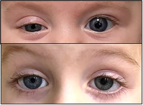 Iris Heterochromia In Acquired Horner Syndrome Following Surgical