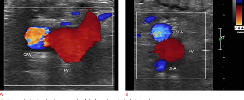 Figure From Doppler Ultrasonography Of The Lower Extremity Arteries Anatomy And Scanning