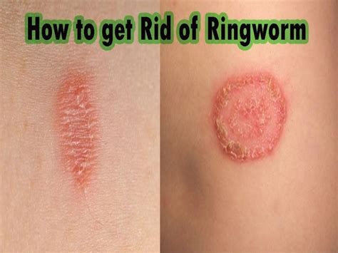 7 Ways To Get Rid Of Ringworm Fast And Permanently At Home