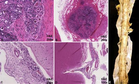 Leptomeningeal Carcinomatosis As Primary Manifestation Of Pancreatic Cancer Journal Of