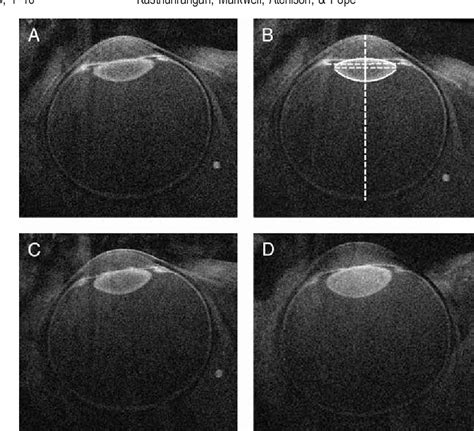 Figure 1 From Mri Study Of The Changes In Crystalline Lens Shape With