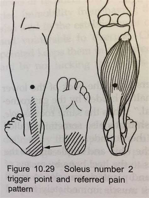 Trigger Point Therapy For Heel Pain Massage Monday 384