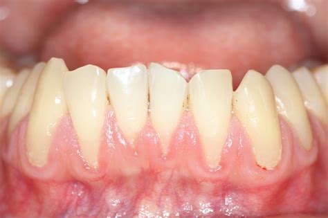 Can Receded Gums Grow Back Valley Dentists Of Belchertown Blog