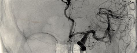 Angiography Cost In India Angiography In India Medsurgeindia