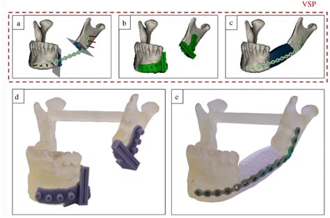 3d Printing Of Bone Grafts The Key Of Correct And Quick Bone Healing