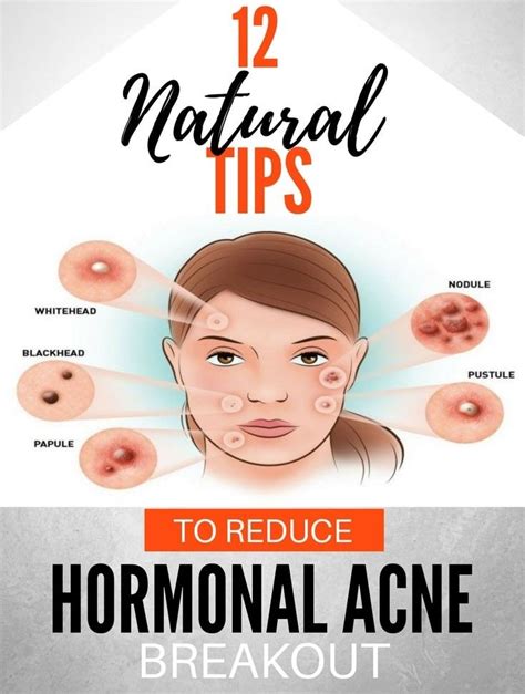 “hormonal Acne” Isnt A Particular Type Of Acne—its Just Plain Old
