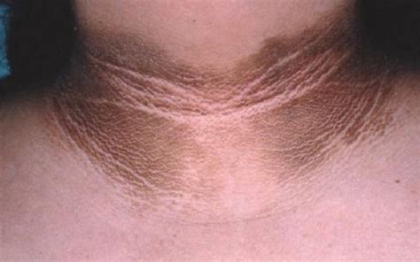 The structures of the human neck are anatomically grouped into four compartments; How To Get Rid Of Black Neck Fast