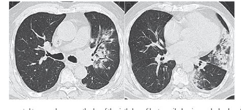 Figure 1 From Bortezomib Induced Severe Pulmonary Complications In
