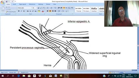 In female fetuses, the ovaries or bowel tissue can spill through the opening and cause a hernia. Hernia 15 ( Direct inguinal hernia , part 2 ) , by Dr. Wahdan - YouTube