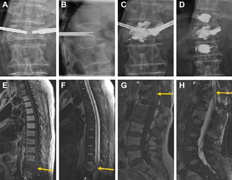 Group A Spinal Metastatic Tumor With Epidural Involvement Of T12