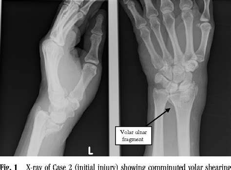 Figure 1 From Beware The Volar Ulnar Fragment In A Comminuted Bartons