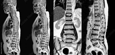 Mri Thoracic Lumbar Spine Moderate Pathological Compression Fracture Of