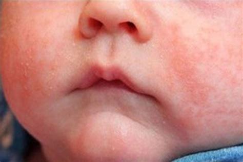 Rashes And Spots Pictures In Toddlers Children And Babies Nhs Doctor