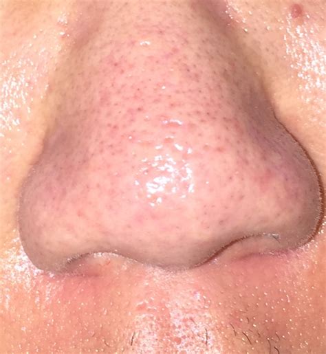 Extremely Large Pores On Nose Several Poses Connected Together Scar