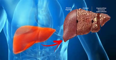 The Truth About Liver Cancer Its Causes And How To Treat It Naturally