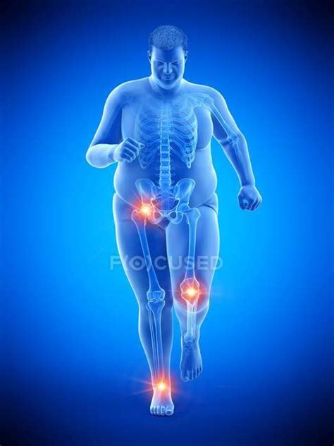 Silhouette Of Running Obese Man With Joint Pain Computer Illustration