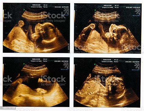 Compilation Of Four Fetus Ultrasounds Stock Photo Download Image Now
