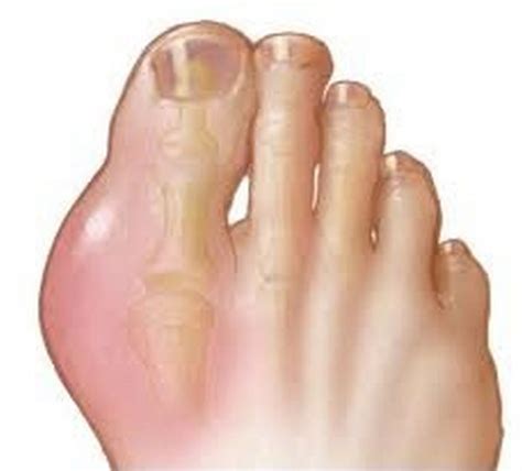 Swelling On The Big Toe Joint Somesolid