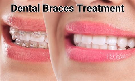 Dental Braces Treatment Best Dental Clinic Istanbul Dentnis