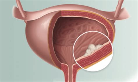 Cystoscopy can be used to take biopsy samples from the bladder or urethra (to find out if an abnormal area is cancer, for example). Bladder Cancer Conferences | Bladder Cancer events ...