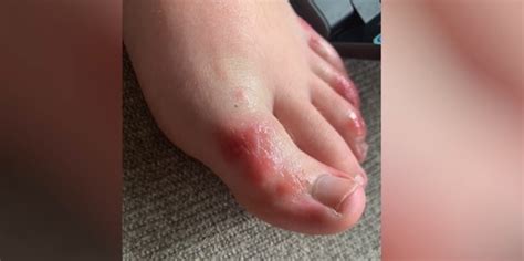 Covid Toes Rash Can Affect Feet In Patients With Coronavirus