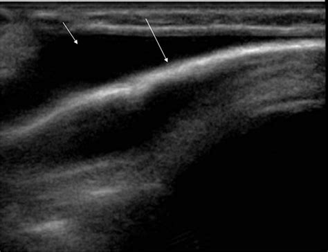 Subaponeurotic Or Subgaleal Fluid Collections In Infancy An Unusual