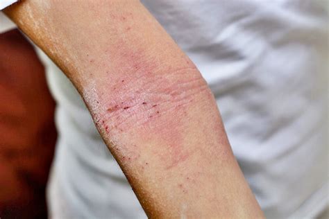 Skin Rash Causes And Treatment