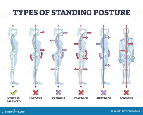 Types Of Standing Postures And Medical Back Pathology Set Outline