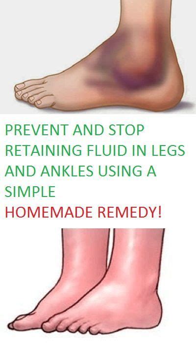 Prevent And Stop Retaining Fluid In Legs And Ankles Using A Simple