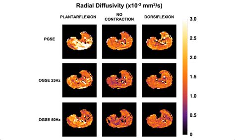 Radial Diffusivity Rd Maps For One Female Volunteer Abnormally