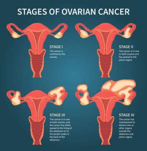 Ovarian Cancer Symptoms Stages Diagnosis Sachin Marda Best Cancer