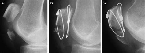 Percutaneous Cerclage Wiring For The Surgical Treatment Of Displaced