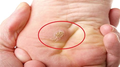 How To Get Rid Of Plantar Warts For Good Fast And Easy Youtube
