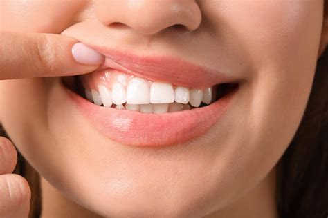 Gums Whitening How To Improve The Appearance Of Your Gums