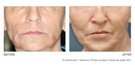 Profound Rf Nonsurgical Facelift Twin Cities Minnesota