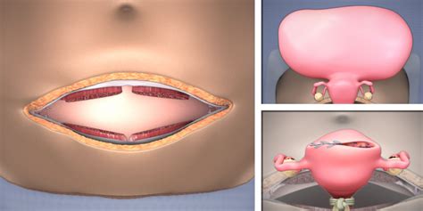 abdominal myomectomy through maylard incision tvasurg the toronto video atlas of surgery