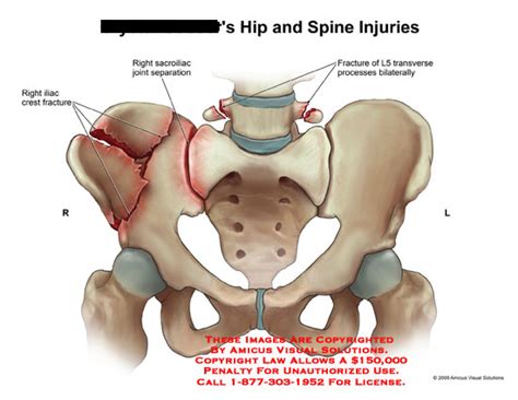 Amicus Illustration Of Amicus Injury Hip Spine Fracture Iliac Crest