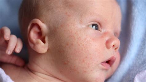Bumps On Babys Face Causes And Remedies Skincarederm