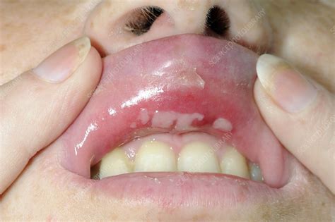 Aphthous Ulcers Inside Upper Lip Stock Image C0106680 Science