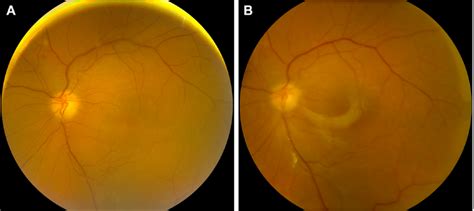 Macula Off Rhegmatogenous Retinal Detachment Secondary To Acute Retinal