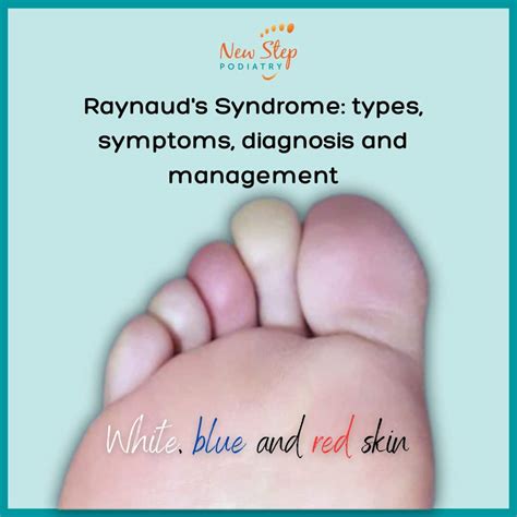 Raynauds Syndrome New Step Podiatry Podiatrists Belconnen Canberra