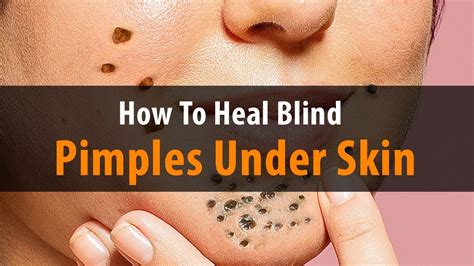 How To Heal Blind Pimples Under The Skin Dr Laelia Youtube