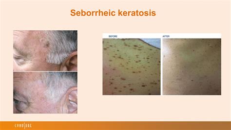 Seborrheic Keratosis Treatment Seborrheic Keratosis Removal