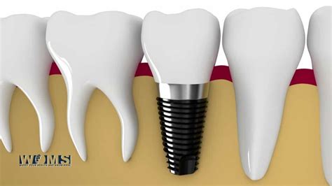 4 Signs That You Need To Look Into Dental Implants Houston For Your