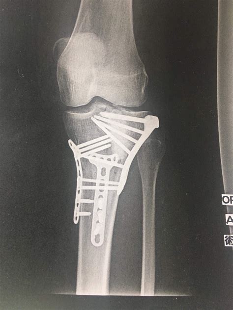 recovery tibial plateau fracture tibial plateau fractures tibial porn sex picture