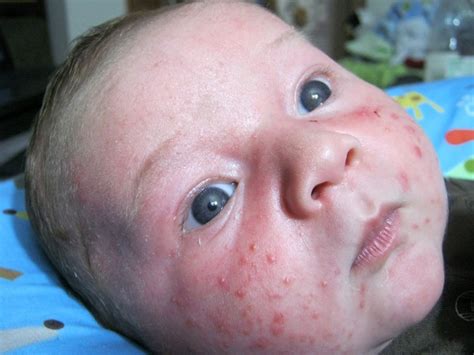 Baby Acne Symptoms Causes Diagnosis And Treatment Natural Health News