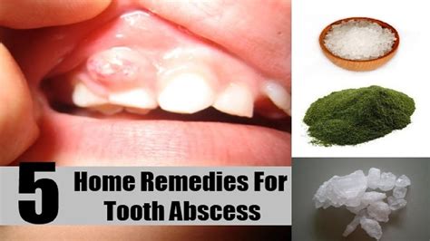 Home Remedies For Abscessed Tooth Home Remedies Natural Cures The Cure