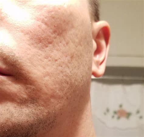 I Need Help Severe Scars Cant Find A Dr Scar Treatments Acne