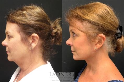 Facelift Neck Lift Before And After Pictures Case 93 Denver Co