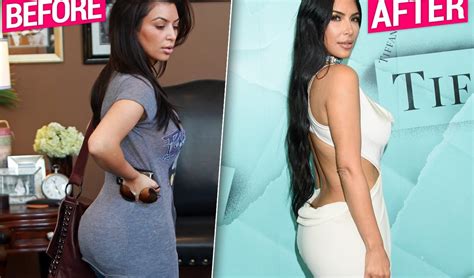 Kim Kardashian Gets Butt Implants Removed Claim Plastic Surgeons